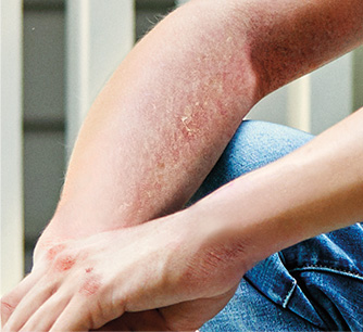 eczema-example