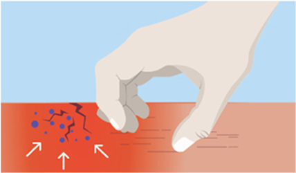 Skin barrier illustration