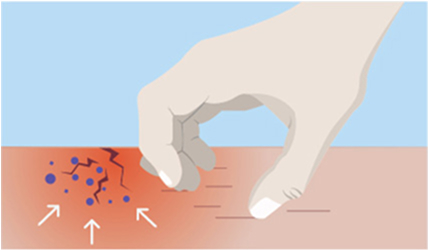 Weakened skin barrier illustration