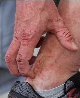 Moderate-to-severe eczema on light, white, pale, fair skin on the neck