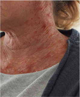 Moderate-to-severe eczema on light, white, pale, fair skin on neck